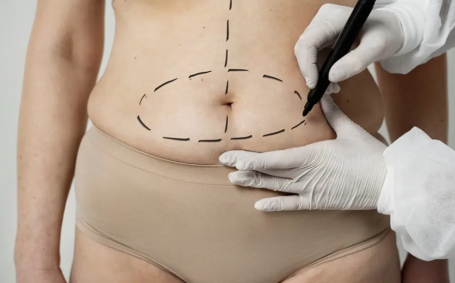 Liposuction Results: Will My Skin Tighten or Sag After Surgery? 2 Patient abdomen marked before liposuction procedure in Bangalore for body contouring and skin tightening