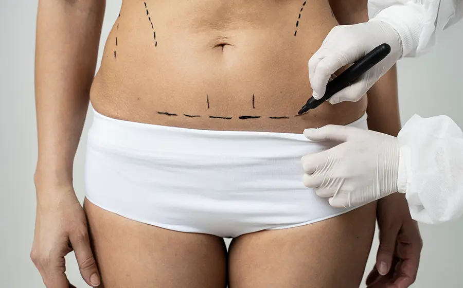 Surgeon marking abdomen before tummy tuck surgery in Bangalore clinic