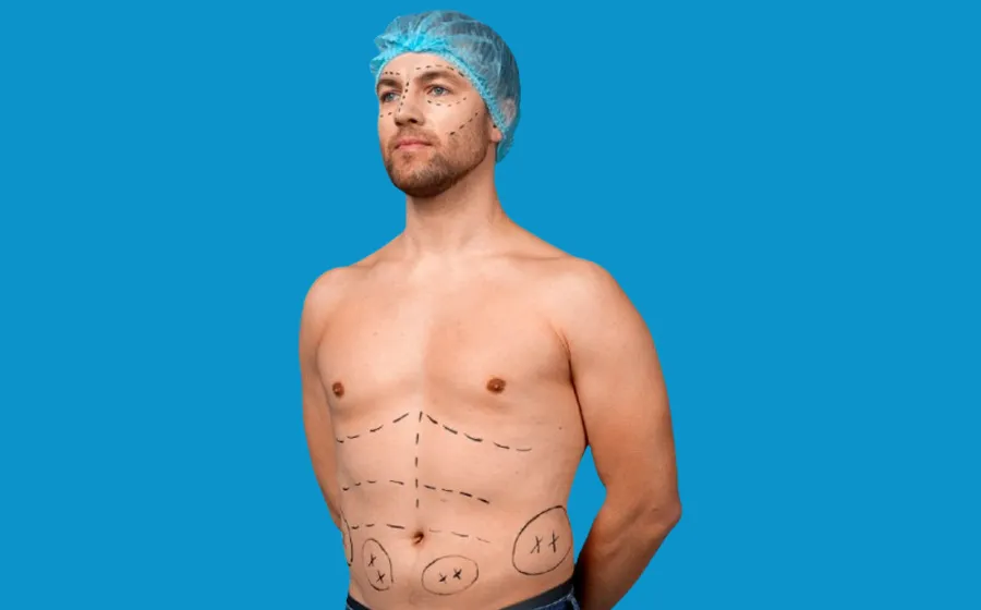 Patient with surgical markings before six pack liposuction procedure