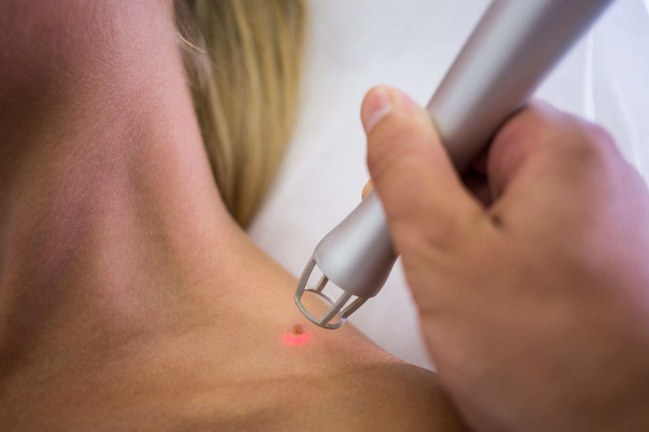 dermatologist removing mole from womans shoulder scaled
