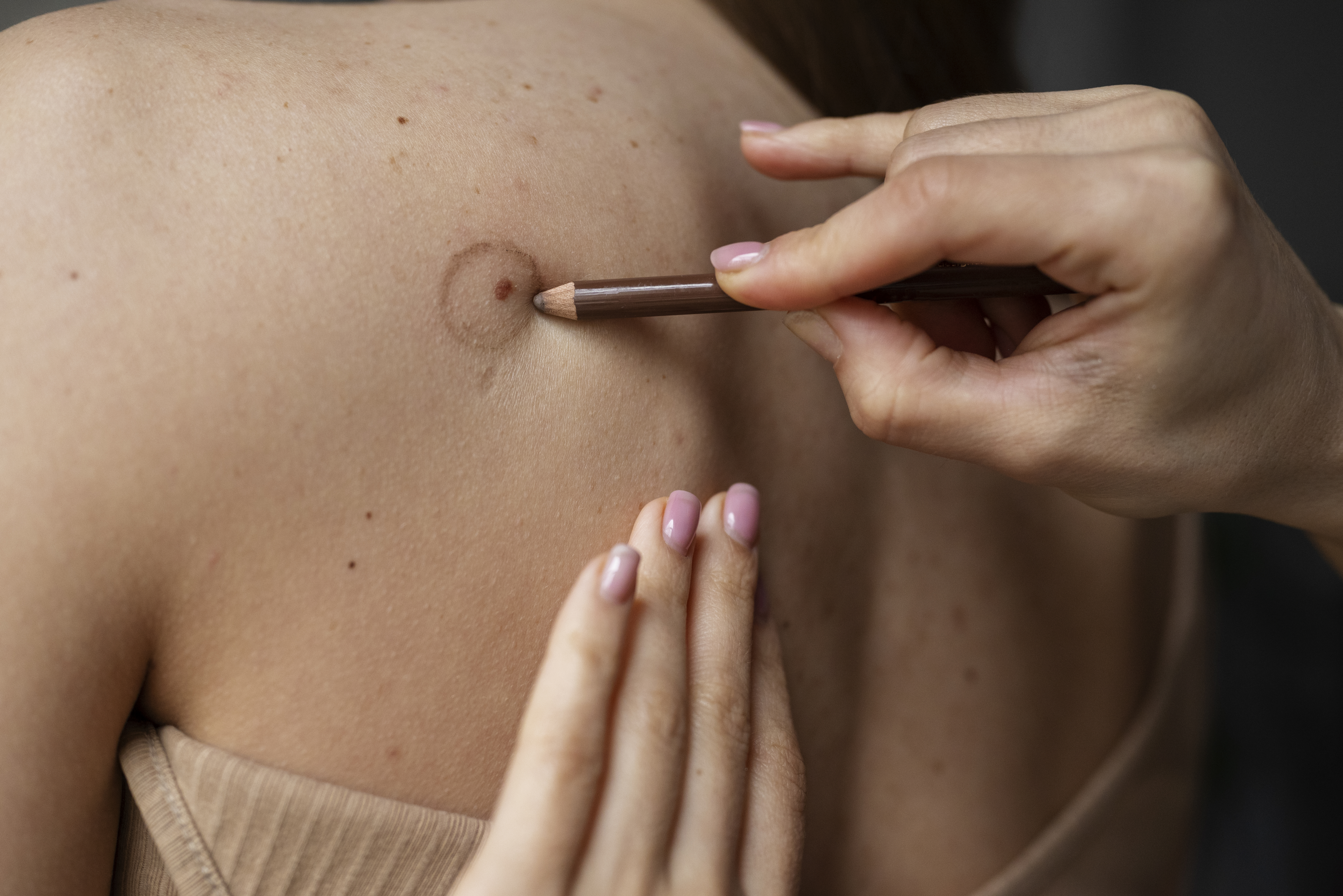 female doctor diagnosing melanoma body female patient