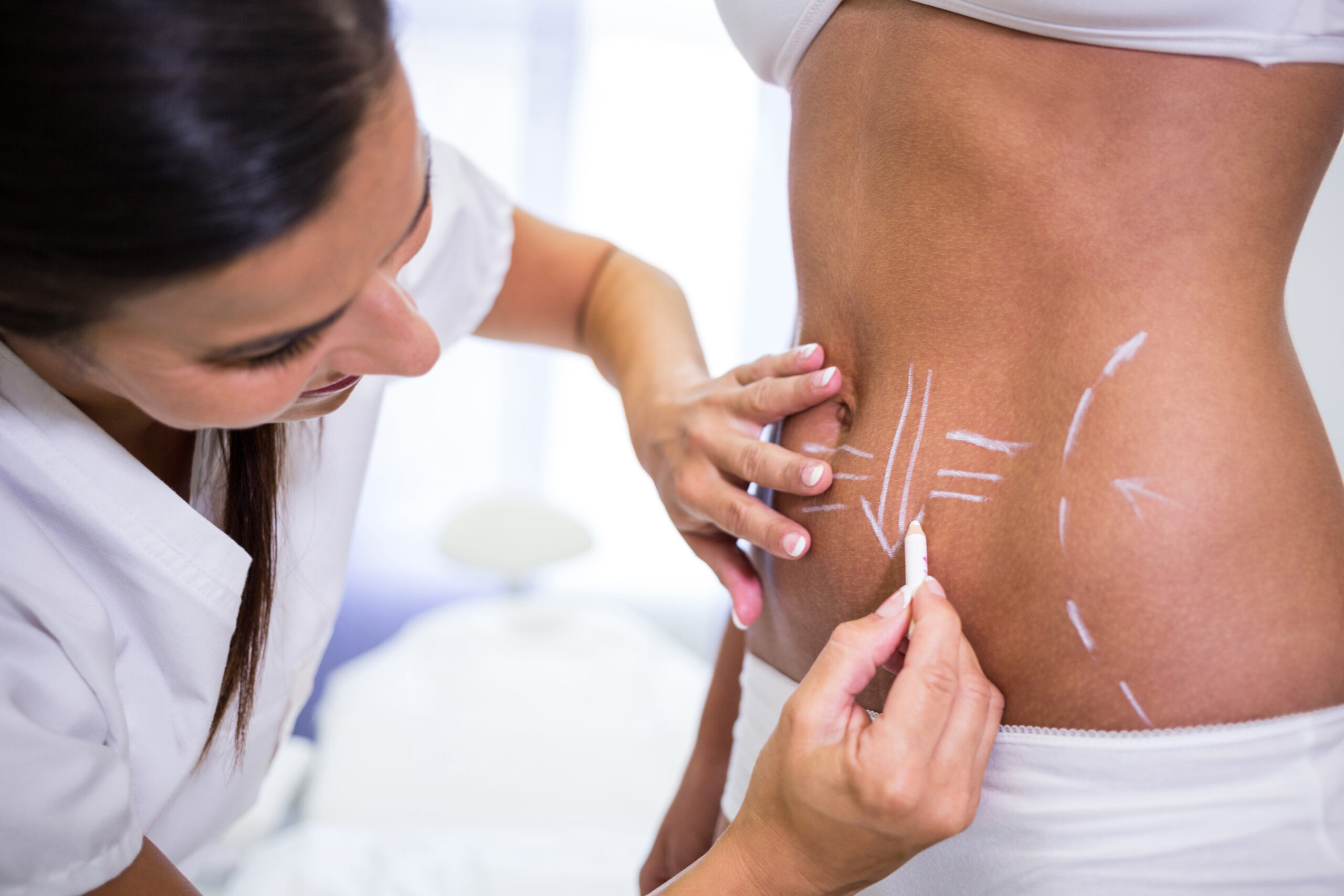 surgeon drawing lines womans abdomen liposuction cellulite removal 1 scaled