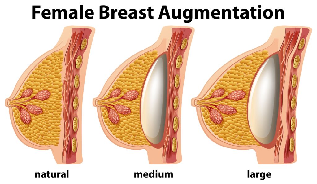 Breast Implant Sizes Explained: How to Choose the Right Size 2 13650.jpg