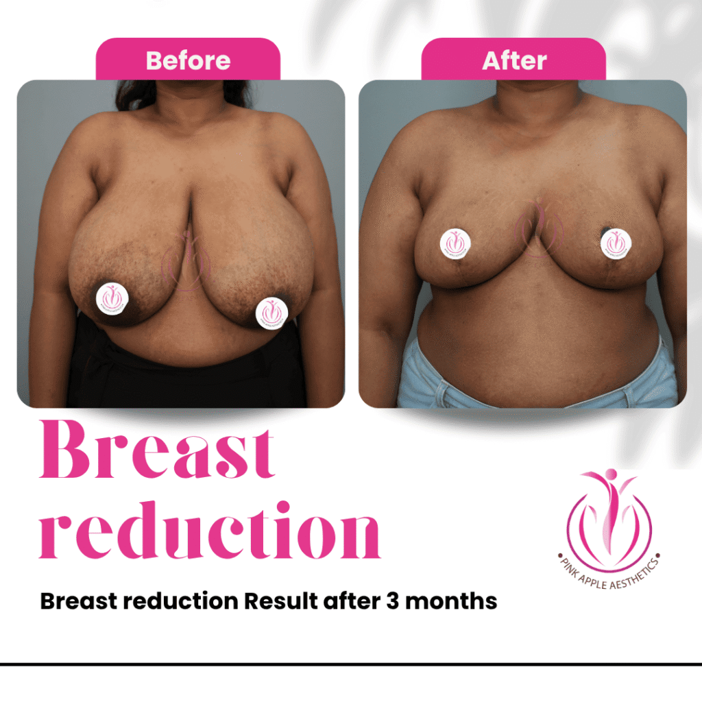 Breast Reduction Before & After Results in Bangalore: Real Patient Outcomes at Pink Apple Aesthetics 5 23