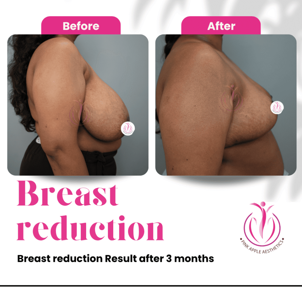 Breast Reduction Before & After Results in Bangalore: Real Patient Outcomes at Pink Apple Aesthetics 4 24