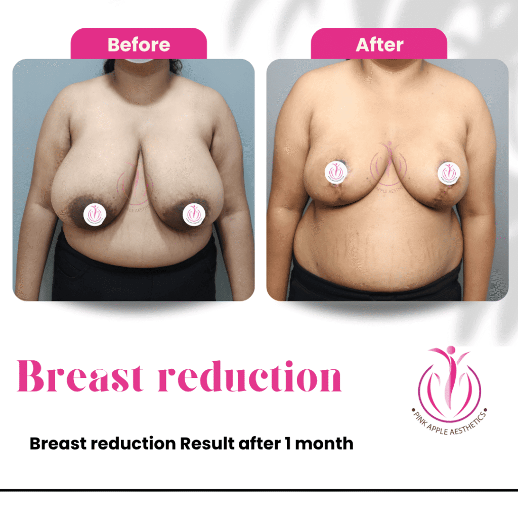 Breast Reduction Before & After Results in Bangalore: Real Patient Outcomes at Pink Apple Aesthetics 3 33