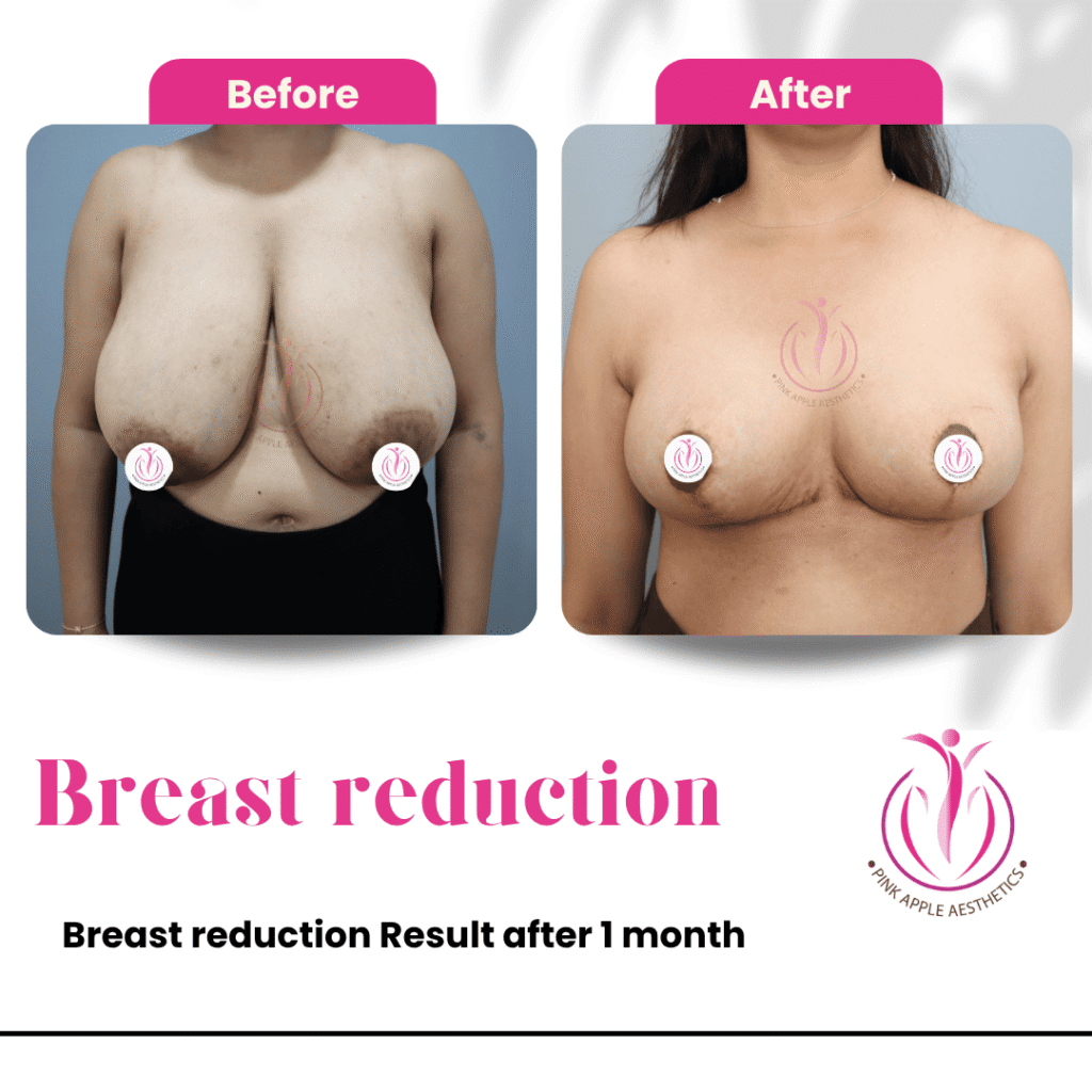 Breast Reduction Before & After Results in Bangalore: Real Patient Outcomes at Pink Apple Aesthetics 2 34