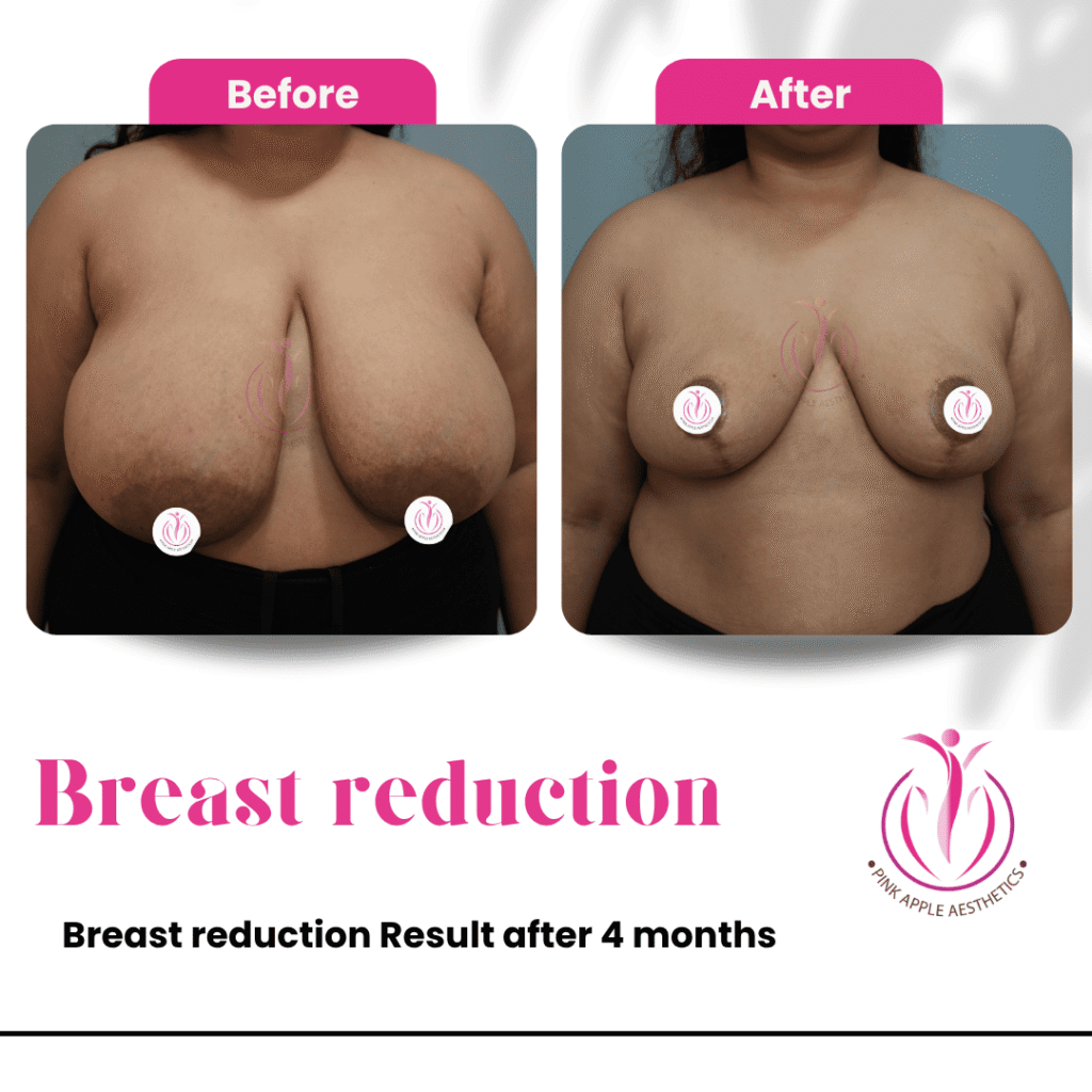 Breast Reduction Before & After Results in Bangalore: Real Patient Outcomes at Pink Apple Aesthetics 6 35