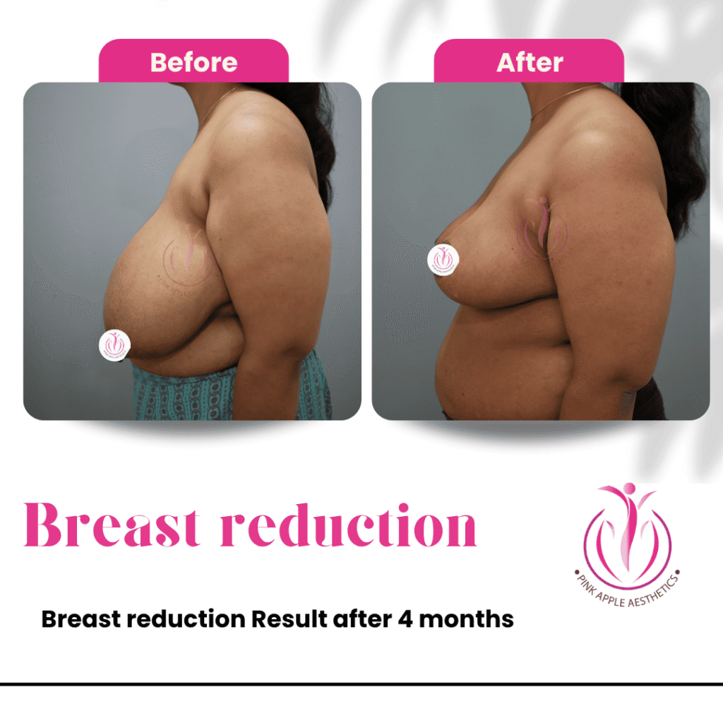 Breast Reduction Before & After Results in Bangalore: Real Patient Outcomes at Pink Apple Aesthetics 7 40