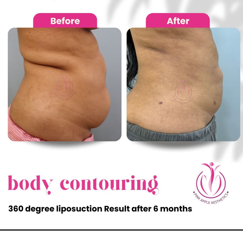 Does Liposuction Hurt? What Patients Actually Experience 2 61 100kb
