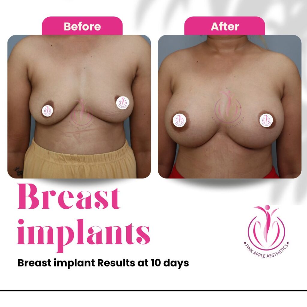 Breast Implants Before & After Results in Bangalore: Real Patient Outcomes at Pink Apple Aesthetics 1 breast implants 100kb