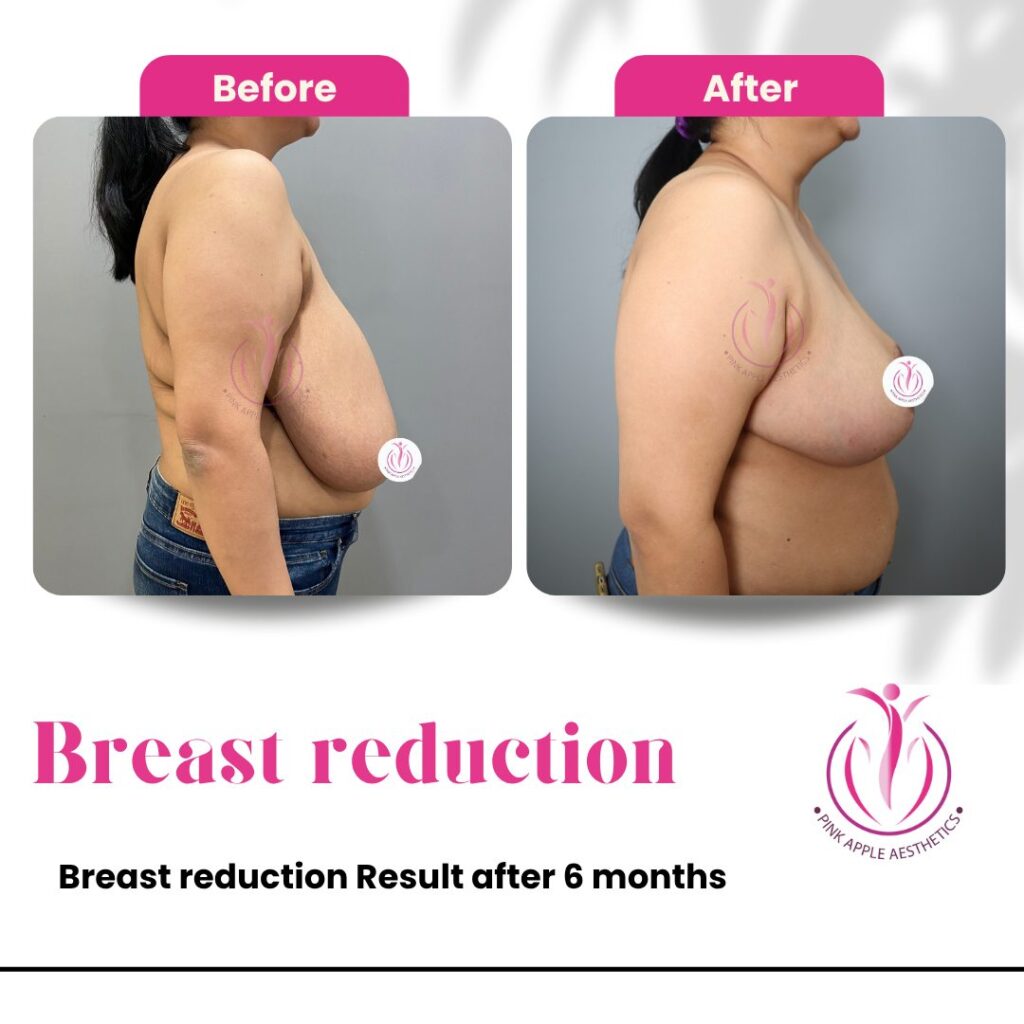 breast reduction 100kb