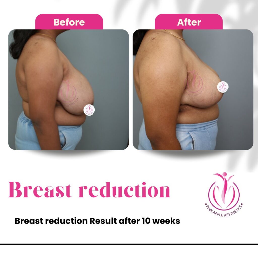 Breast Reduction Before & After: What Results Can You Expect? 3 breast reduction 10 weeks 100kb 1