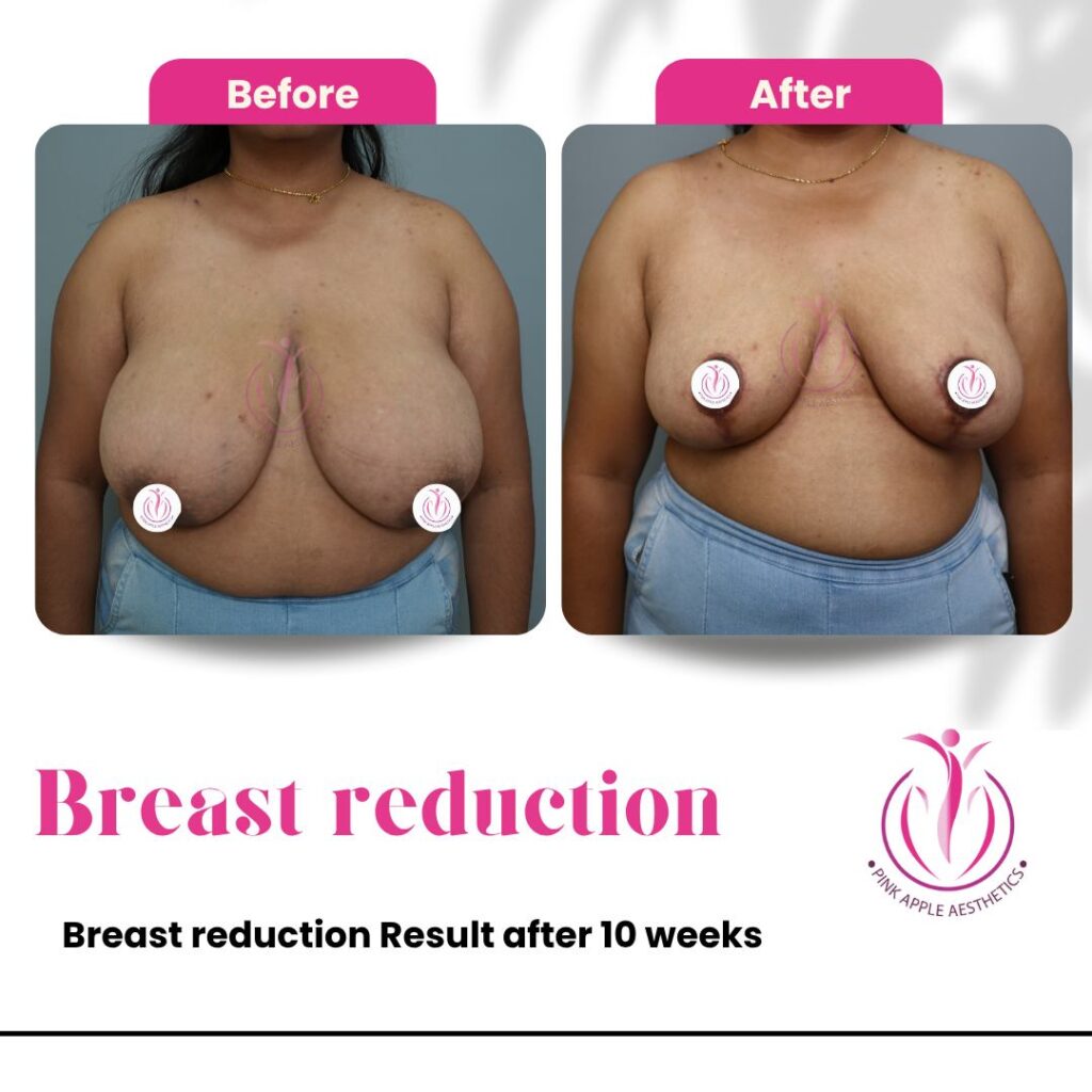 breast reduction 10 weeks under 100kb