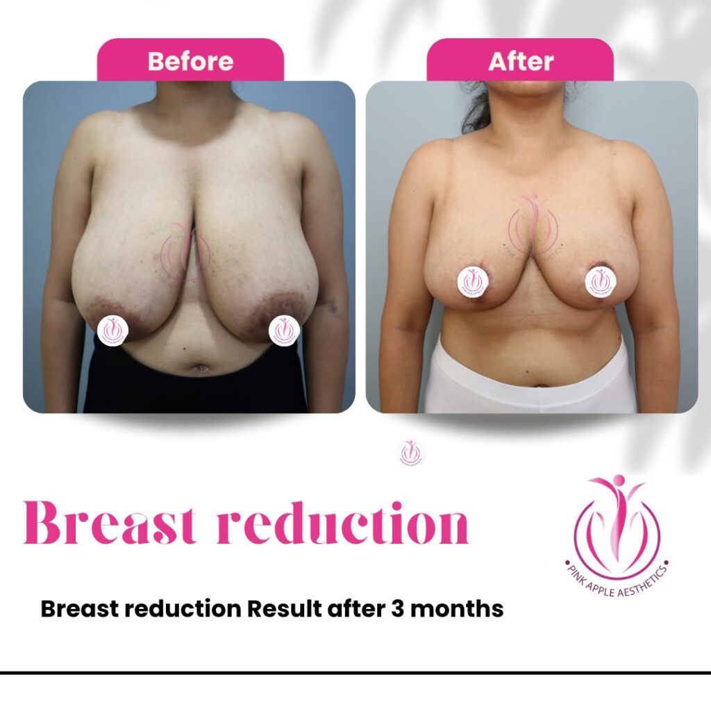 Breast Reduction Surgery in Bangalore: Reasons to Consider It, Benefits, Recovery & Cost 3 Breast Reduction Surgery Bangalore