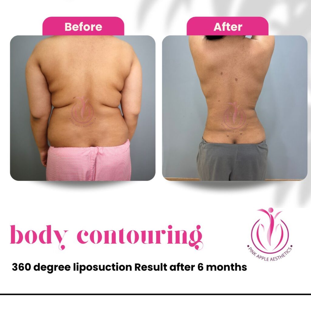 liposuction 360 body contouring