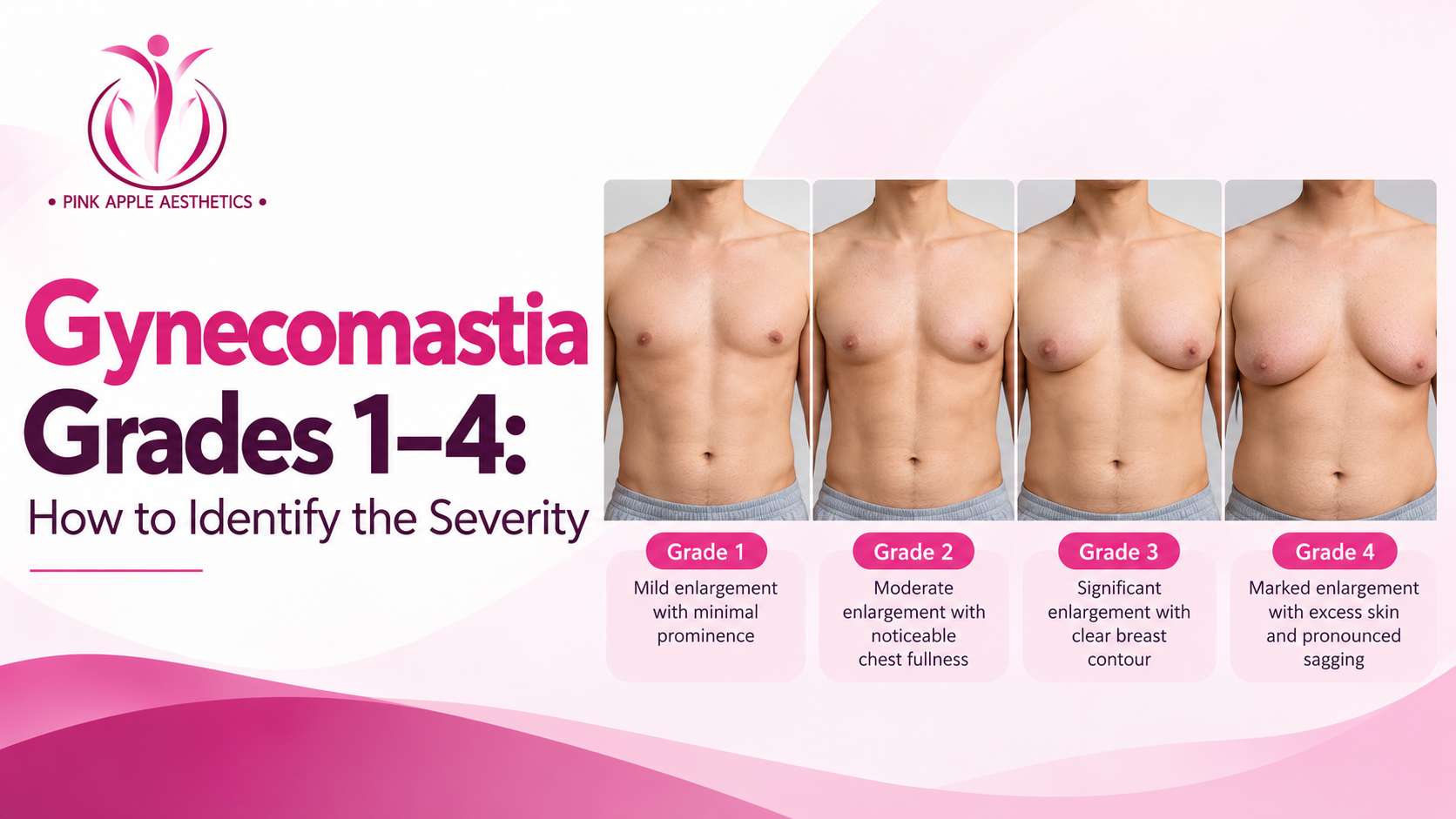 gynecomastia grades blog banner 100kb